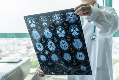 Doctor examining CT scan images of a brain showing signs of Alzheimers disease.